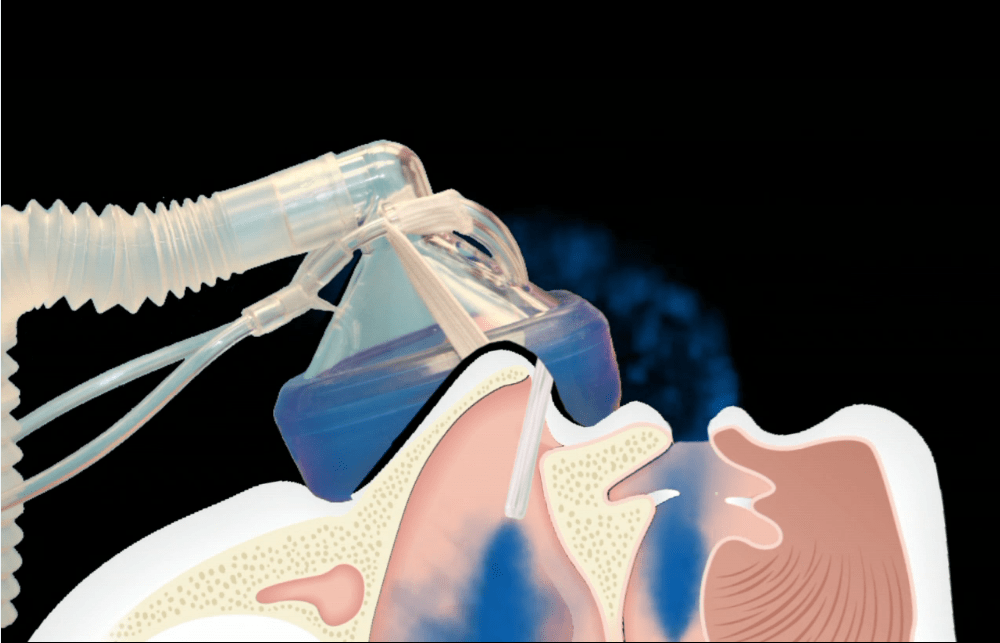 The Rise of a Safer Nitrous Mask System DOCS Education